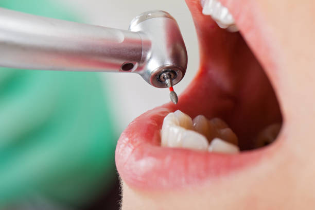 Best Emergency Dental Care for Broken or Chipped Teeth in Pikeville, KY